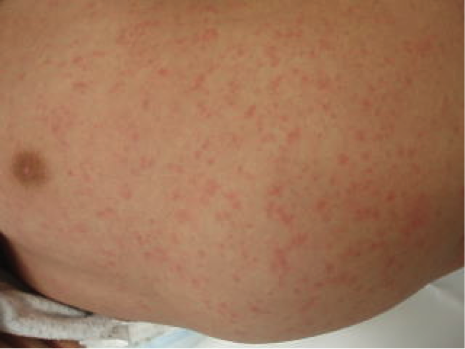 画像付き 幼児がかかりがちな湿疹２０種とその対処法を解説