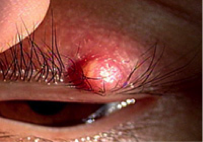 子どもの ものもらい の対処法は 日常生活の過ごし方から予防策まで徹底解説