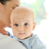 【画像付き】幼児がかかりがちな湿疹２０種とその対処法を解説